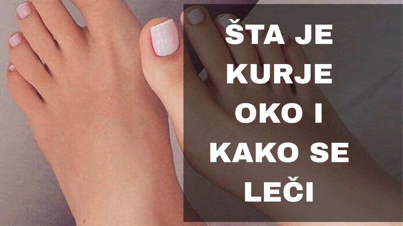 Video Thumbnail: Šta je kurje oko i kako se leči